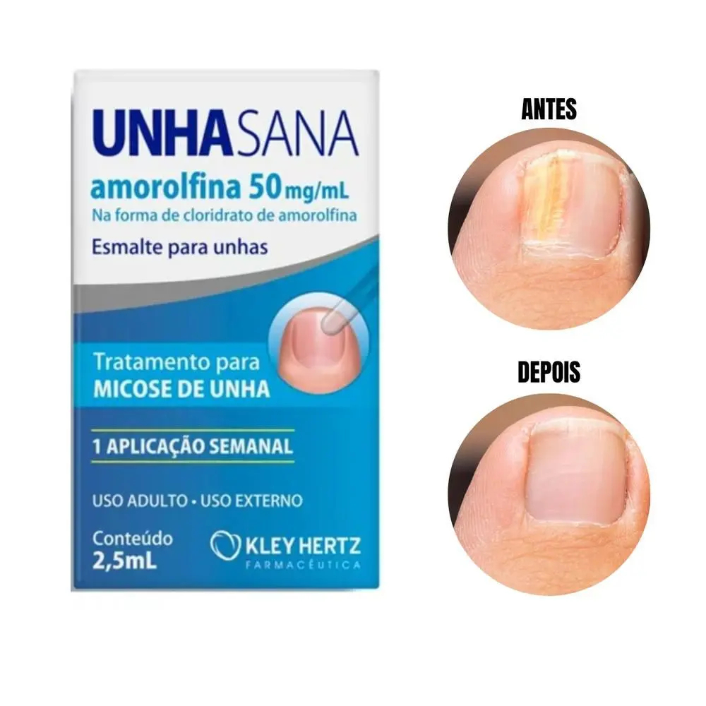 Unhasana Esmalte Amorolfina Tratamento para Micose de Unha e Fortalecimento 2,5ml