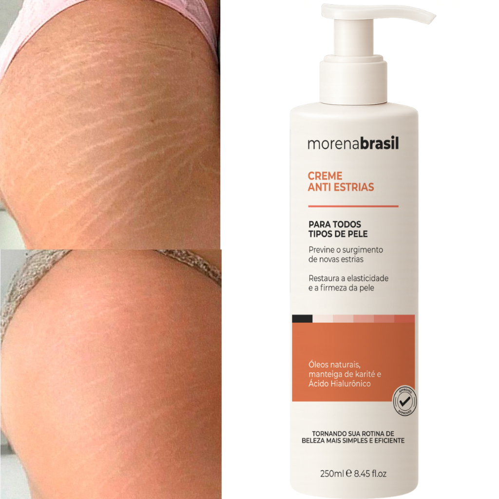 Creme Anti-Estrias Morena Brasil | Previne novas estrias 🦵🏽 Reforça a elasticidade da pele 🧡