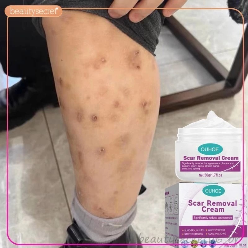 Creme elimina cicatrizes pretas remover feridas antigas mosquitos mordidas espinhas queimar escalas beleza