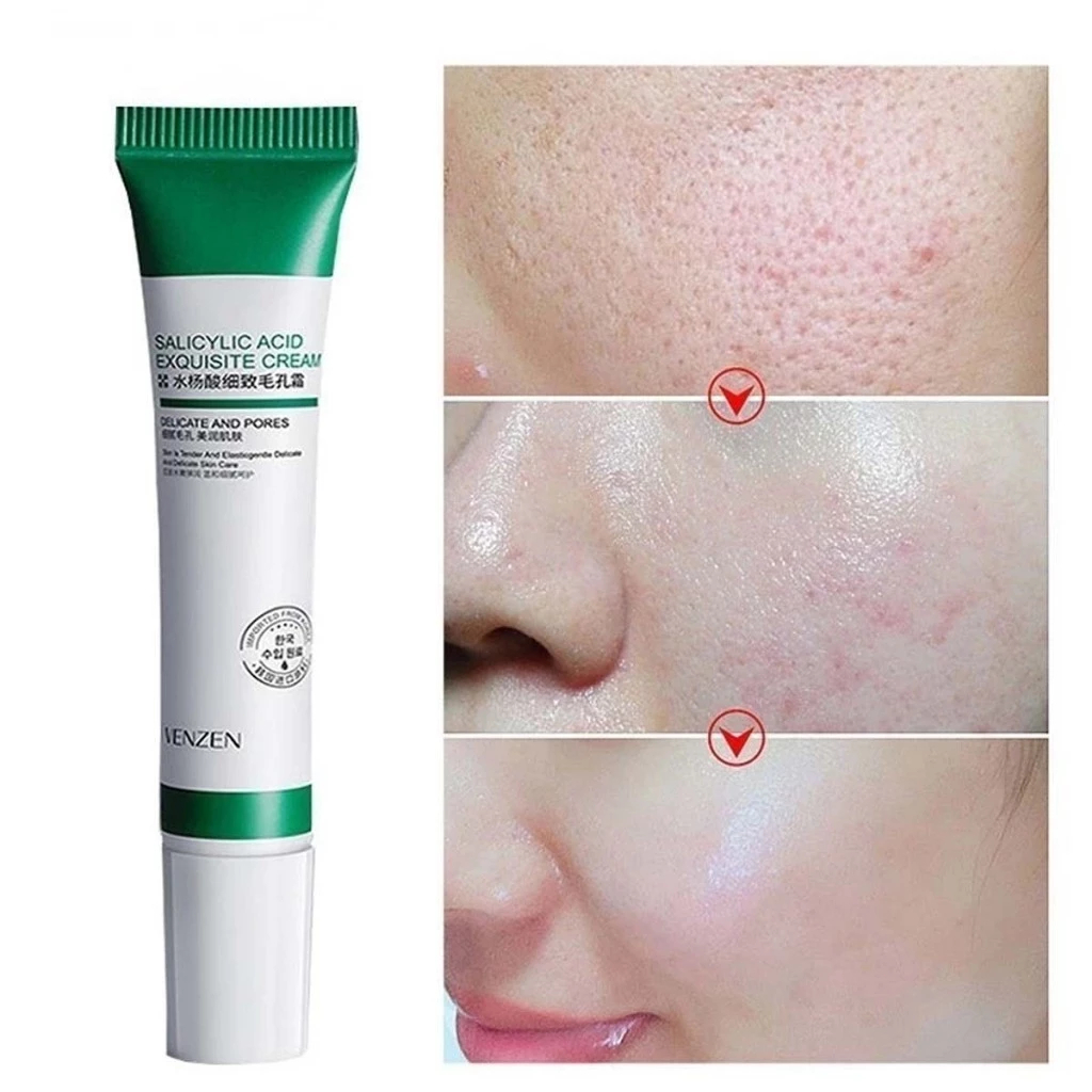 Ácido Salicílico Acne Creme Removedor De Cravo Controle De Óleo Tratamento Anti-Queda Reparação Espinha Cicatriz Claream