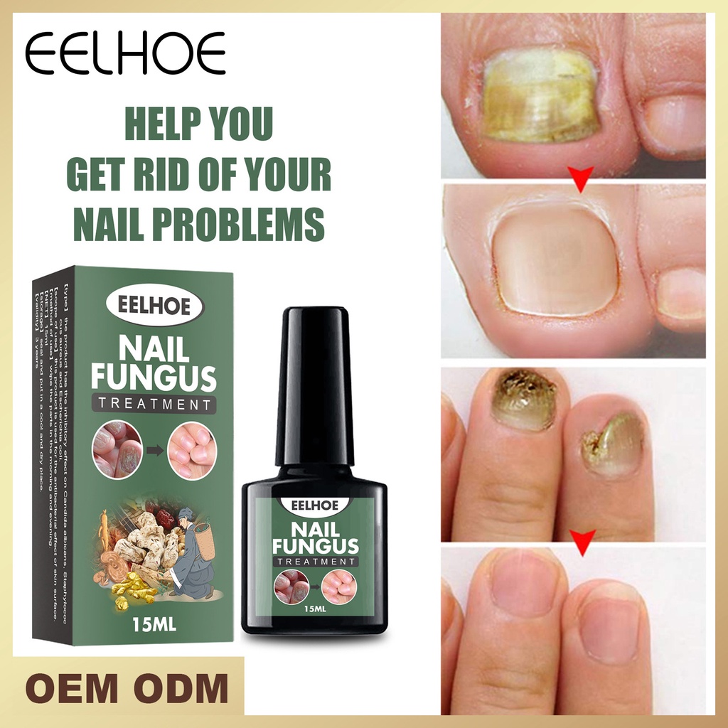 Óleo Essencial para Unhas, Tratamento Contra Fungos em 7 Dias,Soro Reparador de Onychomicose, Cuidado Completo das Unhas