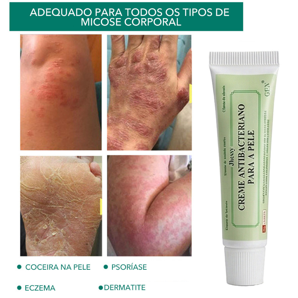 Creme Antibacteriano Para Pele Alivio De Coceira Eczema Psoriase Dermatite Pomada Natural Ervas Puro