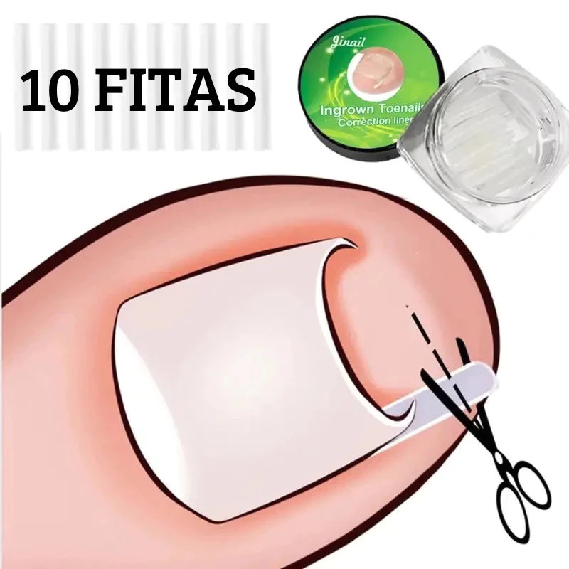 KIT 10 Fitas Órtese Para Unha Encravada Dedo Do Pé
