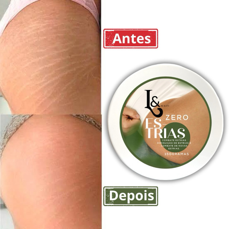 Creme L&BeautyZero Estrias Removedor Anti Estrias Trata E Previne 150g